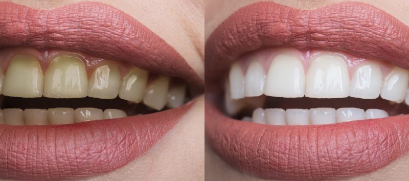 5 Common Myths About Teeth Whitening