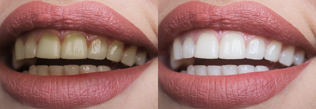 5 Common Myths About Teeth Whitening
