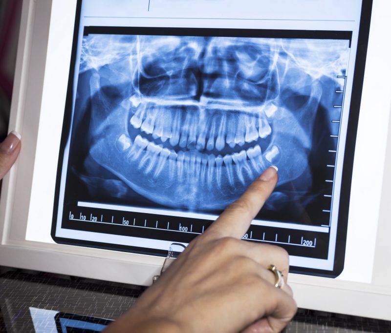 Dental Xrays