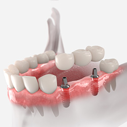 Multiple Dental Implants
